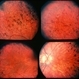 Retinitis Pigmentosa